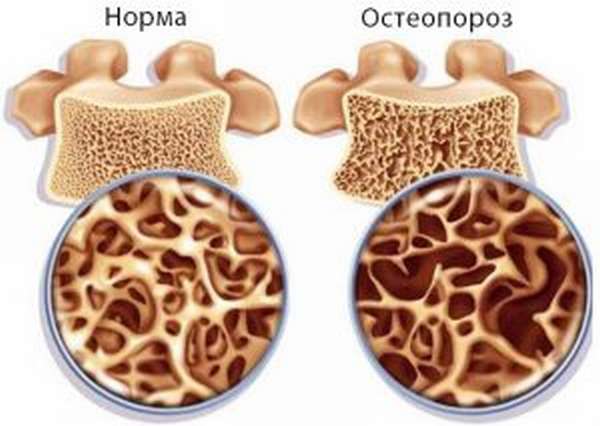 Препараты с кальцием при остеопорозе